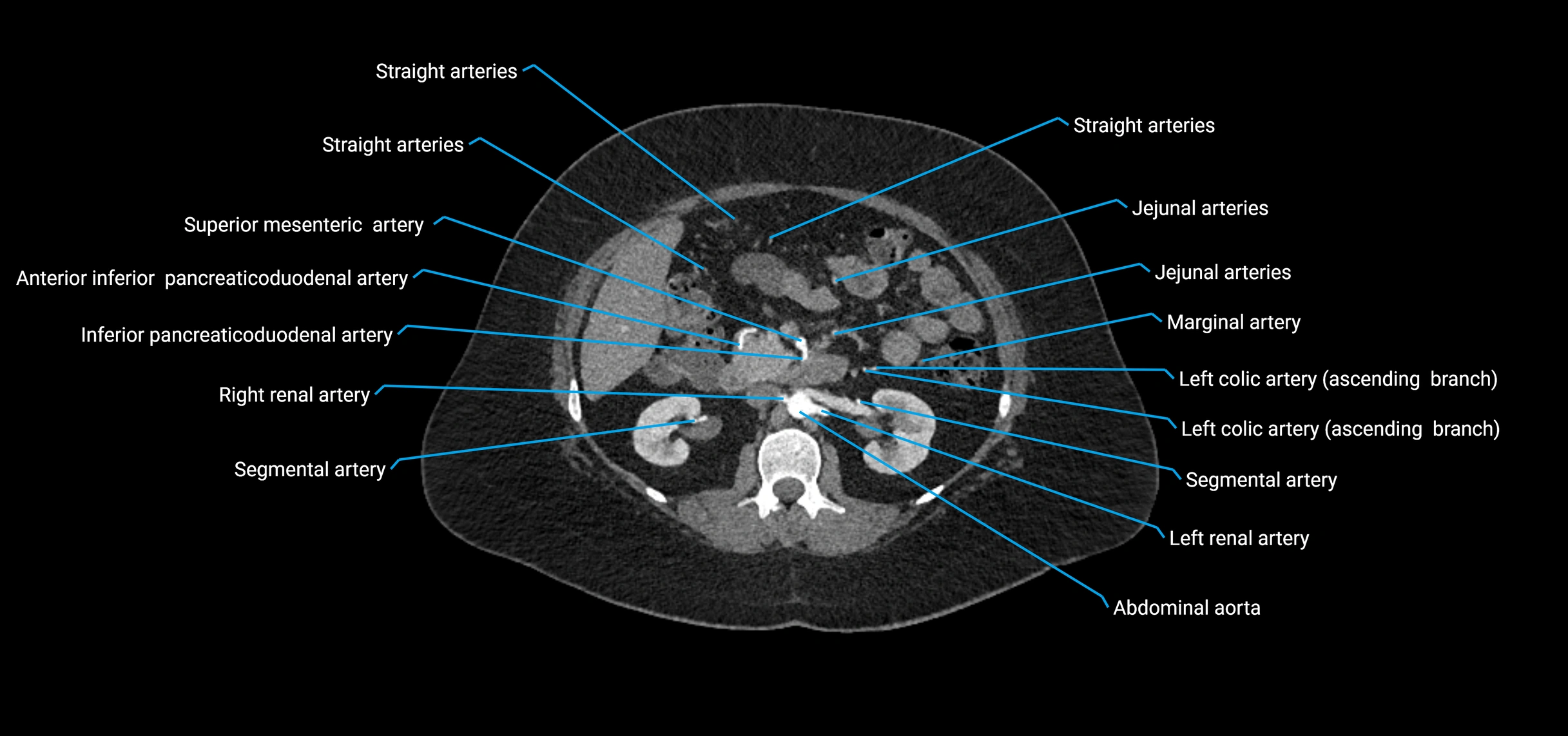 CTA abdomen axial cross sectional anatomy labelled image_76 (2).webp